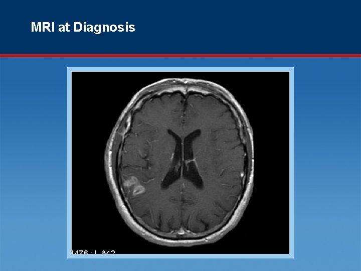 MRI at Diagnosis 