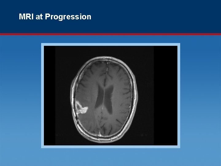 MRI at Progression 