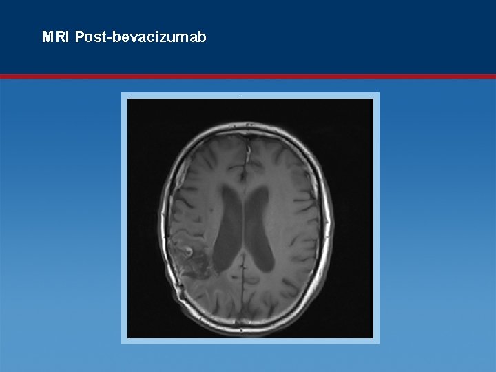 MRI Post-bevacizumab 