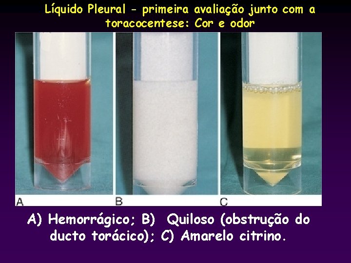 Líquido Pleural - primeira avaliação junto com a toracocentese: Cor e odor A) Hemorrágico;