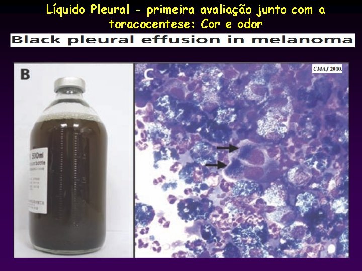 Líquido Pleural - primeira avaliação junto com a toracocentese: Cor e odor 