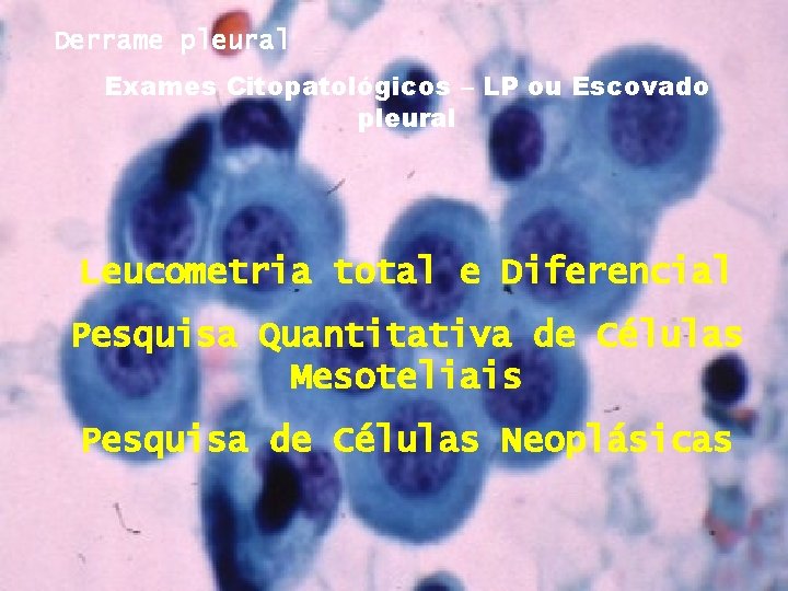 Derrame pleural Exames Citopatológicos – LP ou Escovado pleural Leucometria total e Diferencial Pesquisa