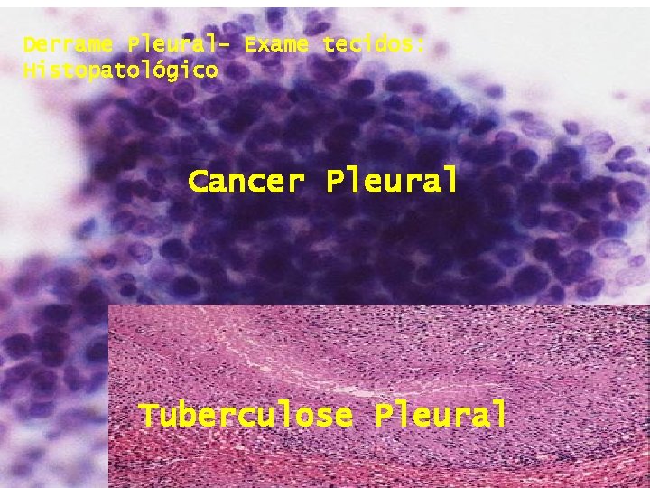 Derrame Pleural- Exame tecidos: Histopatológico Cancer Pleural Tuberculose Pleural 