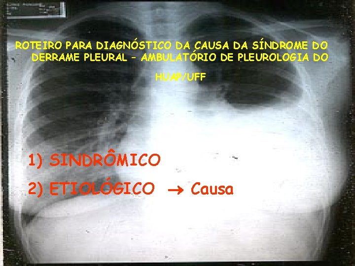 ROTEIRO PARA DIAGNÓSTICO DA CAUSA DA SÍNDROME DO DERRAME PLEURAL – AMBULATÓRIO DE PLEUROLOGIA
