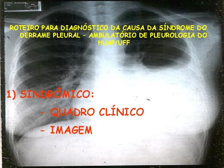  ROTEIRO PARA DIAGNÓSTICO DA CAUSA DA SÍNDROME DO DERRAME PLEURAL – AMBULATÓRIO DE
