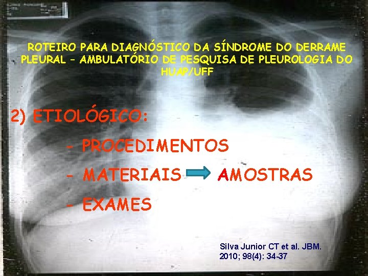 ROTEIRO PARA DIAGNÓSTICO DA SÍNDROME DO DERRAME PLEURAL – AMBULATÓRIO DE PESQUISA DE PLEUROLOGIA