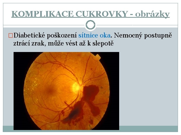 KOMPLIKACE CUKROVKY - obrázky �Diabetické poškození sítnice oka. Nemocný postupně ztrácí zrak, může vést