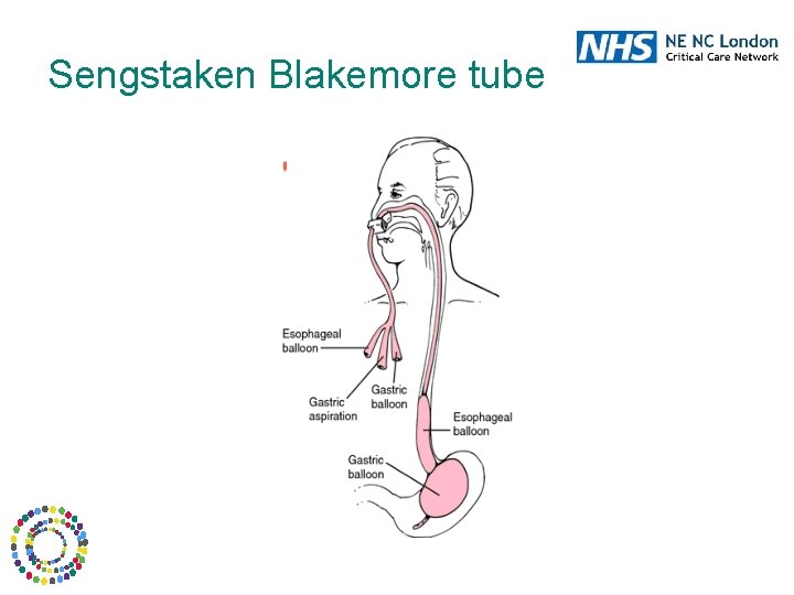 Sengstaken Blakemore tube 