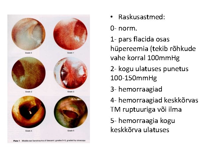  • Raskusastmed: 0 - norm. 1 - pars flacida osas hüpereemia (tekib rõhkude