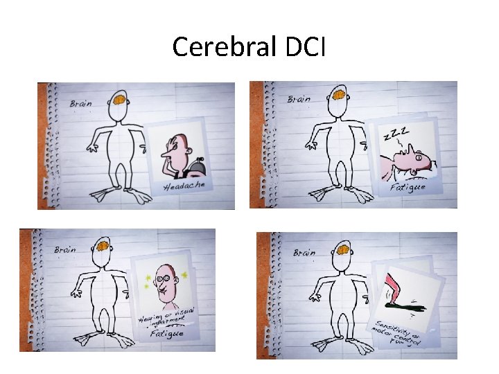 Cerebral DCI 