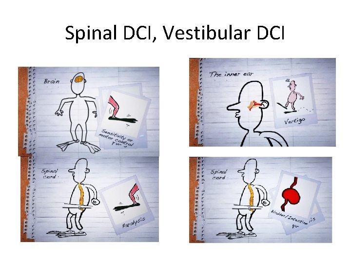 Spinal DCI, Vestibular DCI 