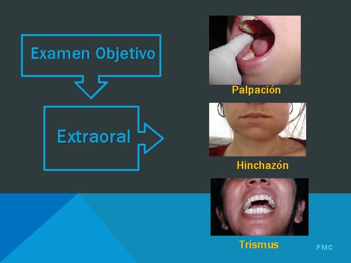 Examen Objetivo Palpación Extraoral Hinchazón Trismus FMC 