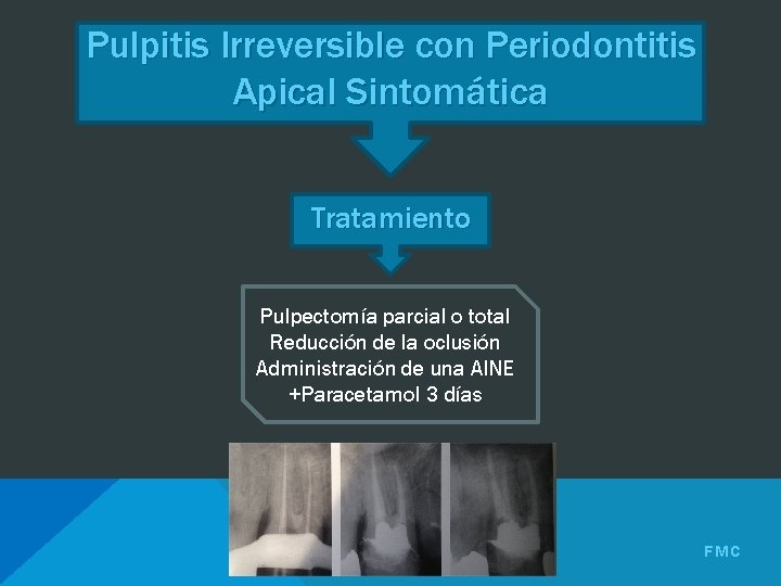 Pulpitis Irreversible con Periodontitis Apical Sintomática Tratamiento Pulpectomía parcial o total Reducción de la