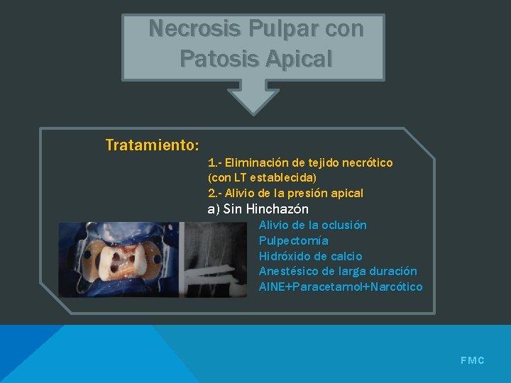 Necrosis Pulpar con Patosis Apical Tratamiento: 1. - Eliminación de tejido necrótico (con LT