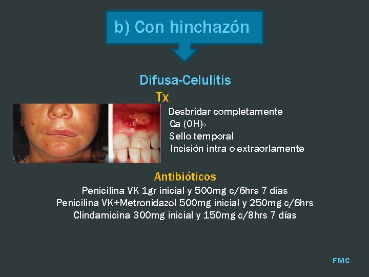 b) Con hinchazón Difusa-Celulitis Tx Desbridar completamente Ca (OH)2 Sello temporal Incisión intra o