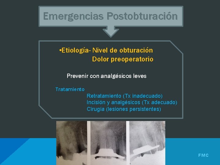 Emergencias Postobturación • Etiología- Nivel de obturación Dolor preoperatorio Prevenir con analgésicos leves Tratamiento