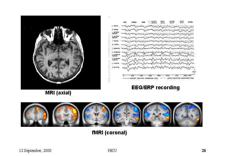 EEG/ERP recording MRI (axial) f. MRI (coronal) 12 September, 2000 HKU 26 