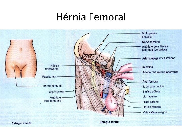 Hérnia Femoral Hérnia Femoral