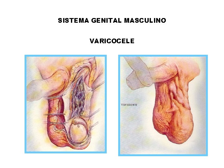 SISTEMA GENITAL MASCULINO VARICOCELE 