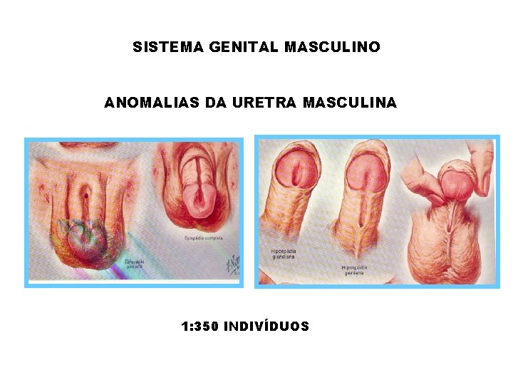 SISTEMA GENITAL MASCULINO ANOMALIAS DA URETRA MASCULINA 1: 350 INDIVÍDUOS 