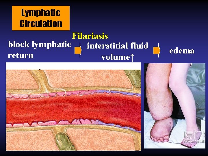 Lymphatic Circulation Filariasis block lymphatic interstitial fluid return volume↑ edema 