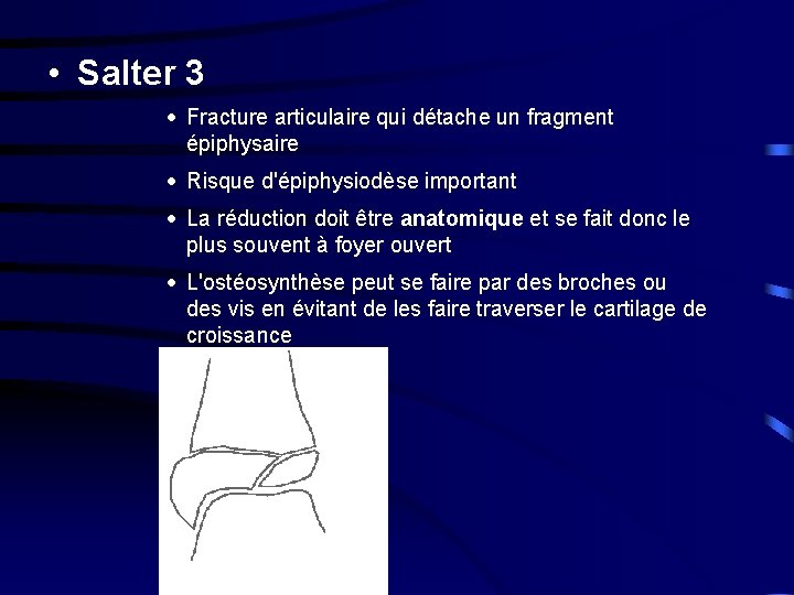  • Salter 3 · Fracture articulaire qui détache un fragment épiphysaire · Risque
