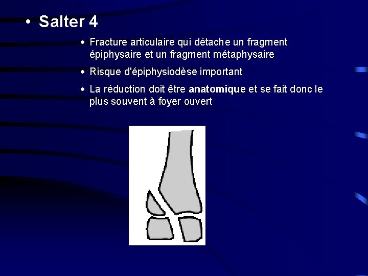  • Salter 4 · Fracture articulaire qui détache un fragment épiphysaire et un