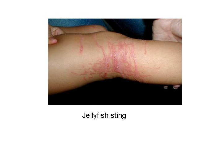 Jellyfish sting 