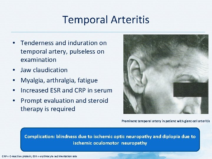 Temporal Arteritis • Tenderness and induration on temporal artery, pulseless on examination • Jaw Temporal Arteritis • Tenderness and induration on temporal artery, pulseless on examination • Jaw