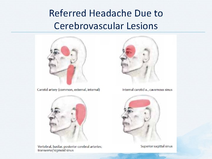 Referred Headache Due to Cerebrovascular Lesions Referred Headache Due to Cerebrovascular Lesions