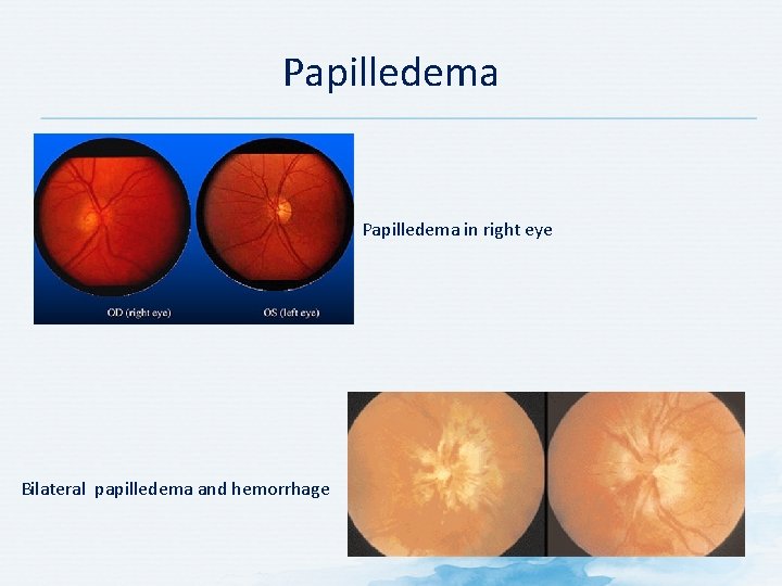Papilledema in right eye Bilateral papilledema and hemorrhage Papilledema in right eye Bilateral papilledema and hemorrhage