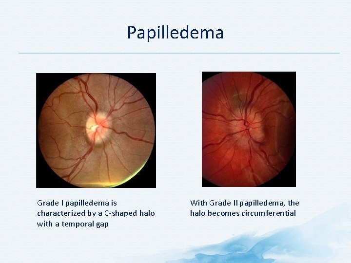 Papilledema Grade I papilledema is characterized by a C shaped halo with a temporal Papilledema Grade I papilledema is characterized by a C shaped halo with a temporal