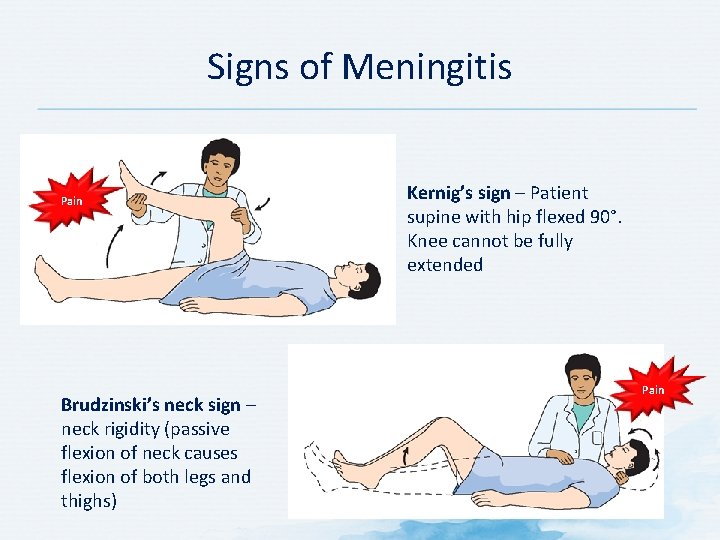 Signs of Meningitis Pain Brudzinski’s neck sign – neck rigidity (passive flexion of neck Signs of Meningitis Pain Brudzinski’s neck sign – neck rigidity (passive flexion of neck
