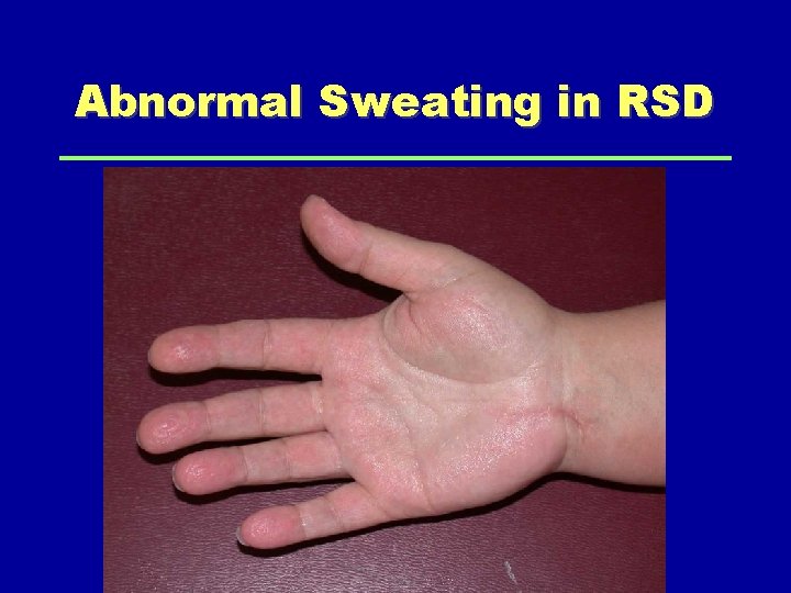 Abnormal Sweating in RSD 