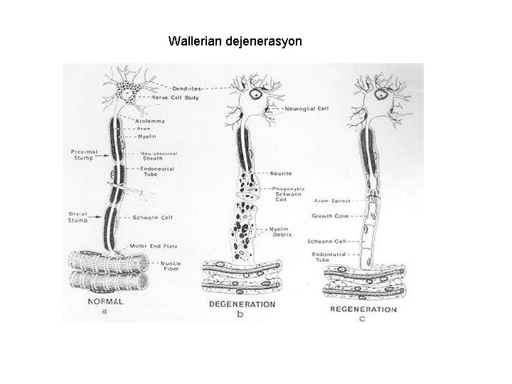 Wallerian dejenerasyon Wallerian dejenerasyon