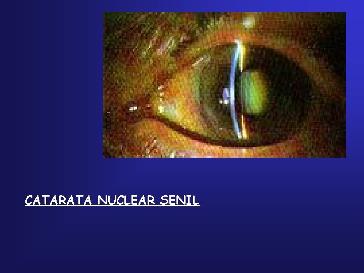 CATARATA NUCLEAR SENIL 