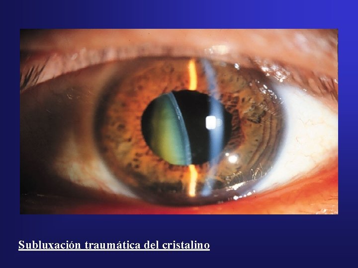 Subluxación traumática del cristalino 