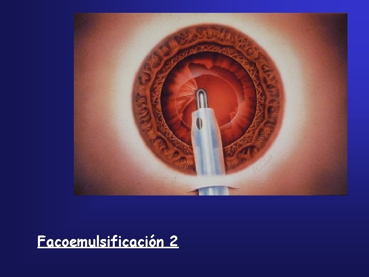 Facoemulsificación 2 