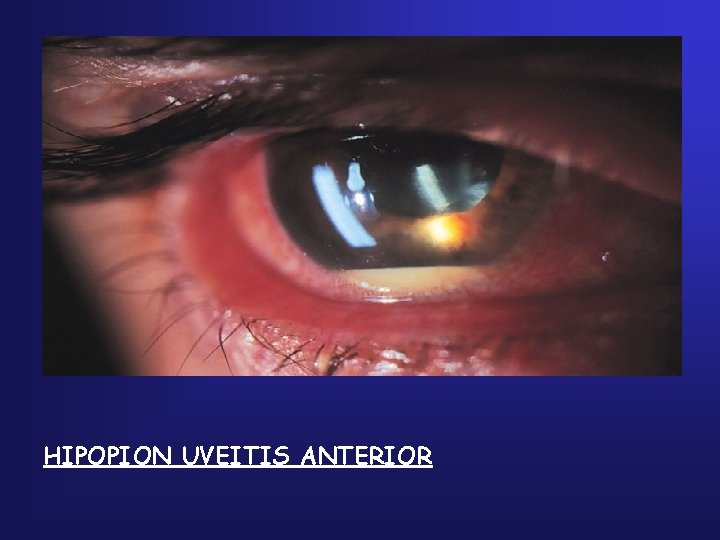 HIPOPION UVEITIS ANTERIOR 