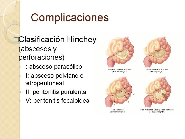 Complicaciones �Clasificación Hinchey (abscesos y perforaciones) ◦ I: absceso paracólico ◦ II: absceso pelviano