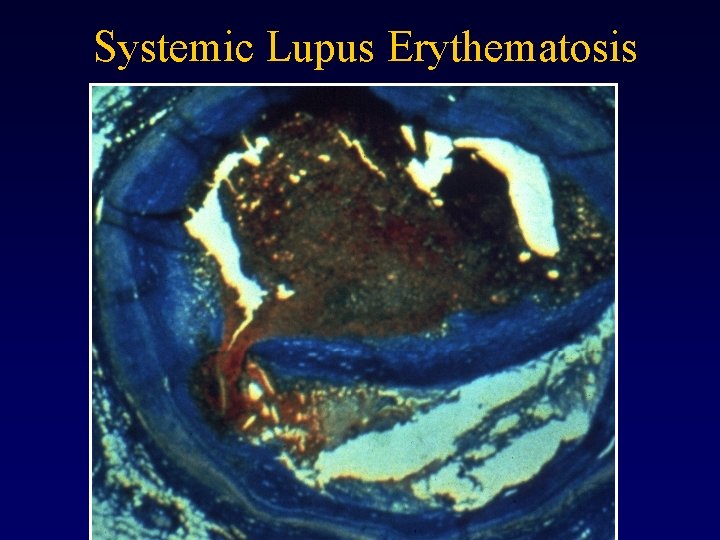 Systemic Lupus Erythematosis 