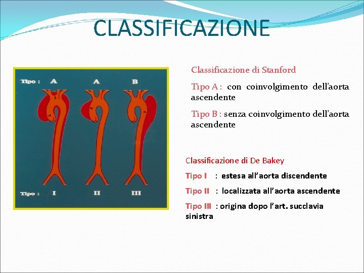 CLASSIFICAZIONE Classificazione di Stanford Tipo A : con coinvolgimento dell’aorta ascendente Tipo B :