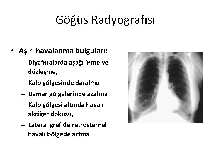 Göğüs Radyografisi • Aşırı havalanma bulguları: – Diyafmalarda aşağı inme ve düzleşme, – Kalp Göğüs Radyografisi • Aşırı havalanma bulguları: – Diyafmalarda aşağı inme ve düzleşme, – Kalp