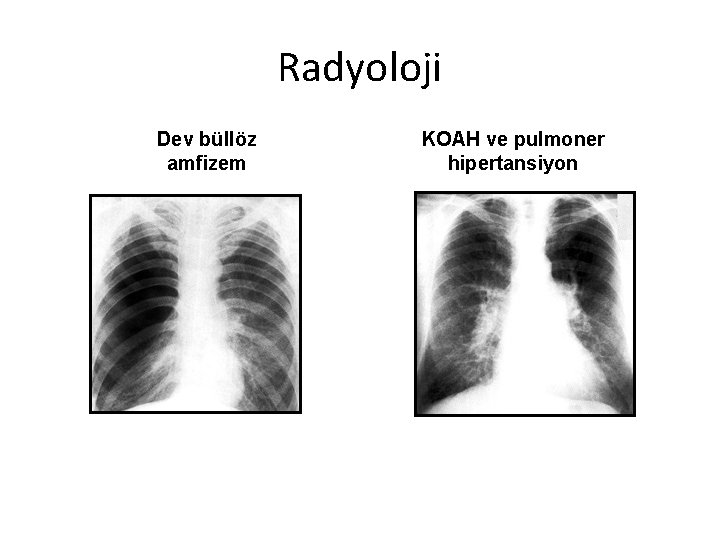 Radyoloji Dev büllöz amfizem KOAH ve pulmoner hipertansiyon Radyoloji Dev büllöz amfizem KOAH ve pulmoner hipertansiyon