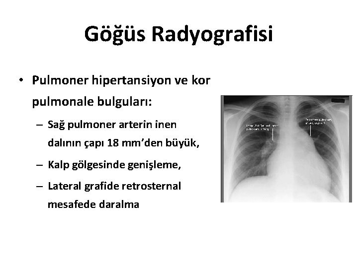 Göğüs Radyografisi • Pulmoner hipertansiyon ve kor pulmonale bulguları: – Sağ pulmoner arterin inen Göğüs Radyografisi • Pulmoner hipertansiyon ve kor pulmonale bulguları: – Sağ pulmoner arterin inen