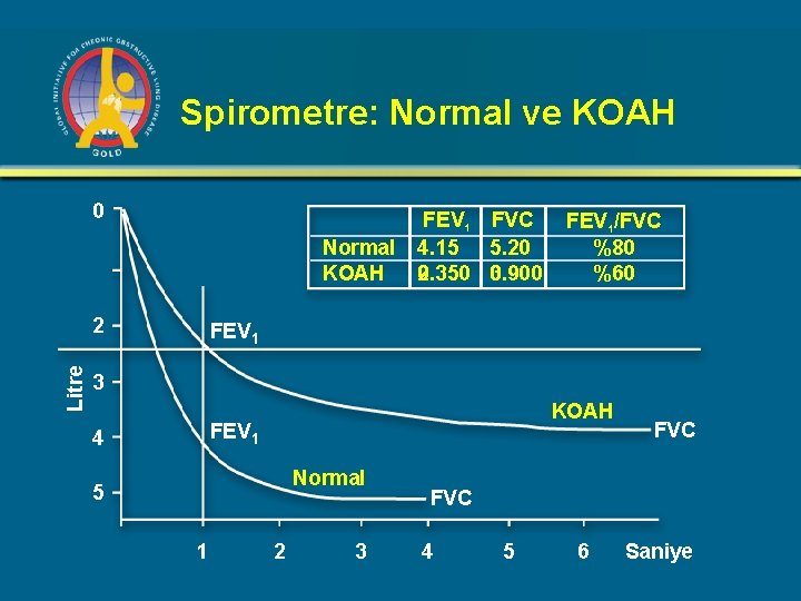 Spirometre: Normal ve KOAH 0 Normal KOAH Litre 2 FEV 1 FVC 4. 15 Spirometre: Normal ve KOAH 0 Normal KOAH Litre 2 FEV 1 FVC 4. 15