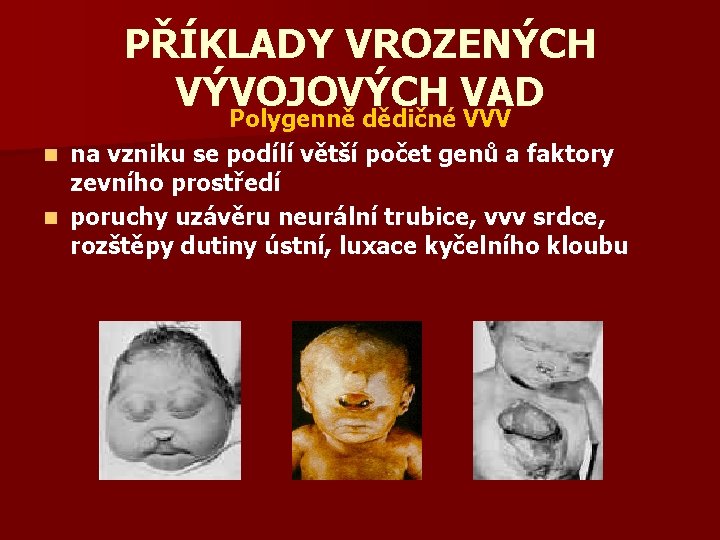 PŘÍKLADY VROZENÝCH VÝVOJOVÝCH VAD Polygenně dědičné VVV n na vzniku se podílí větší počet