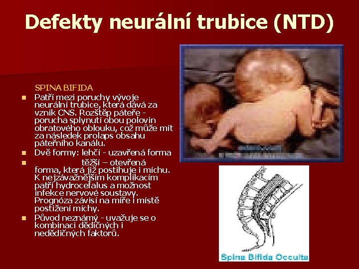 Defekty neurální trubice (NTD) SPINA BIFIDA n Patří mezi poruchy vývoje neurální trubice, která