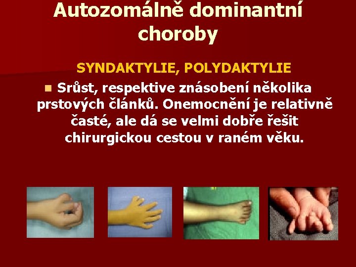Autozomálně dominantní choroby SYNDAKTYLIE, POLYDAKTYLIE n Srůst, respektive znásobení několika prstových článků. Onemocnění je