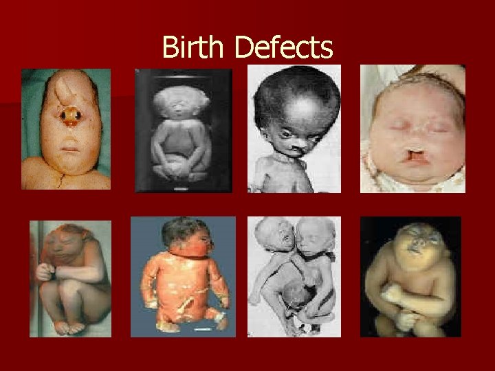 Birth Defects 